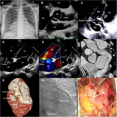 Case report: Surgical repair for left main coronary artery to right atrium fistula with endocarditis